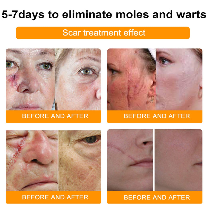 LOVILDS™ Bee Poison Wart & Tag Removal Cream(👨‍⚕Suitable for all skin types)🐝