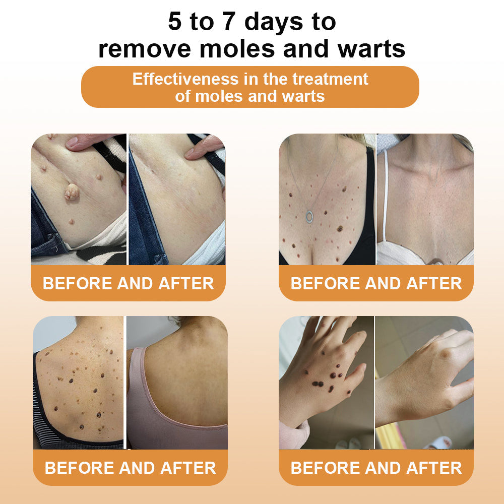 LOVILDS™ Bee Poison Wart & Tag Removal Cream(👨‍⚕Suitable for all skin types)🐝