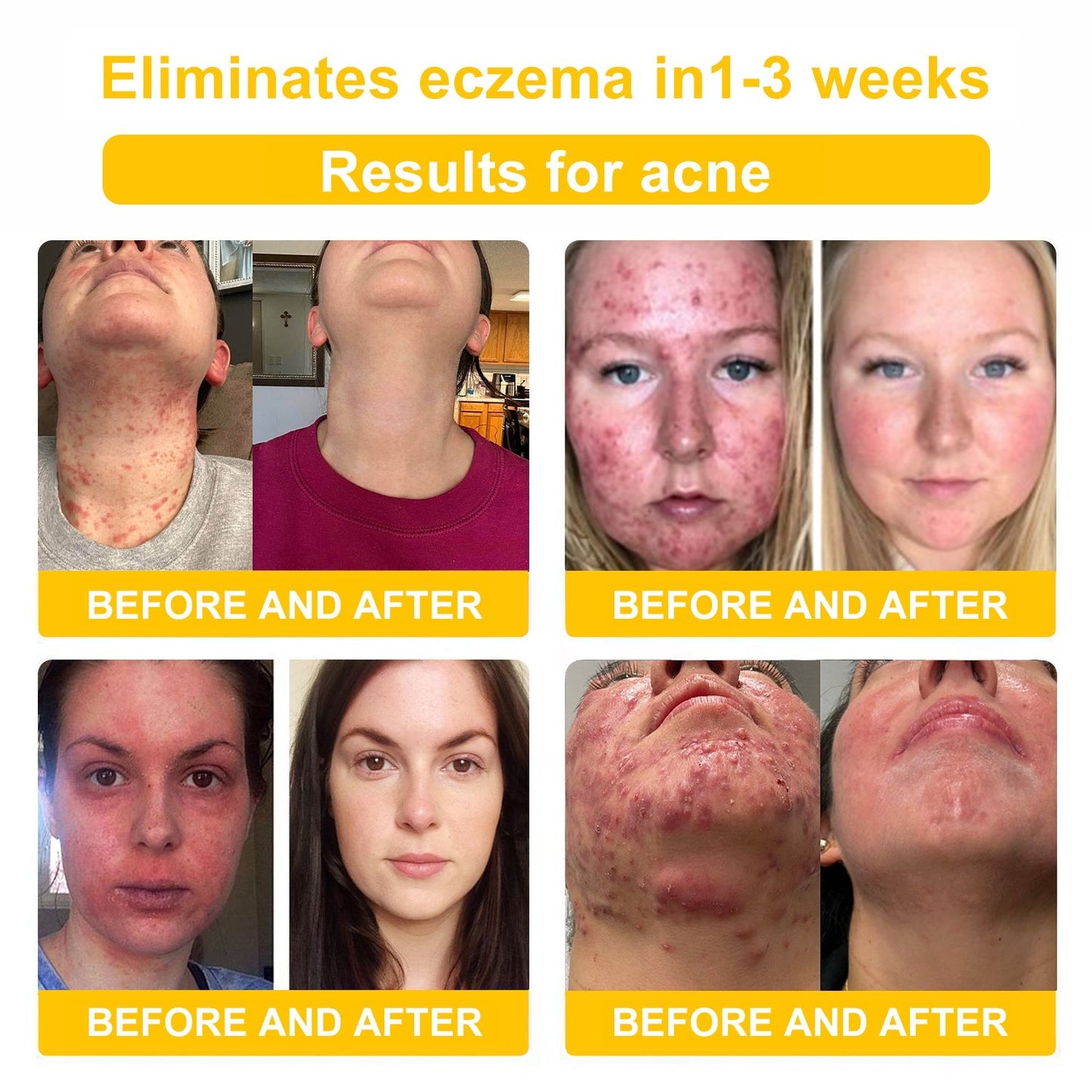 NESLEMY™ Bee Poison Skin Cream（👨‍⚕AAD Recommended),for Remove Warts, Acne and Scars