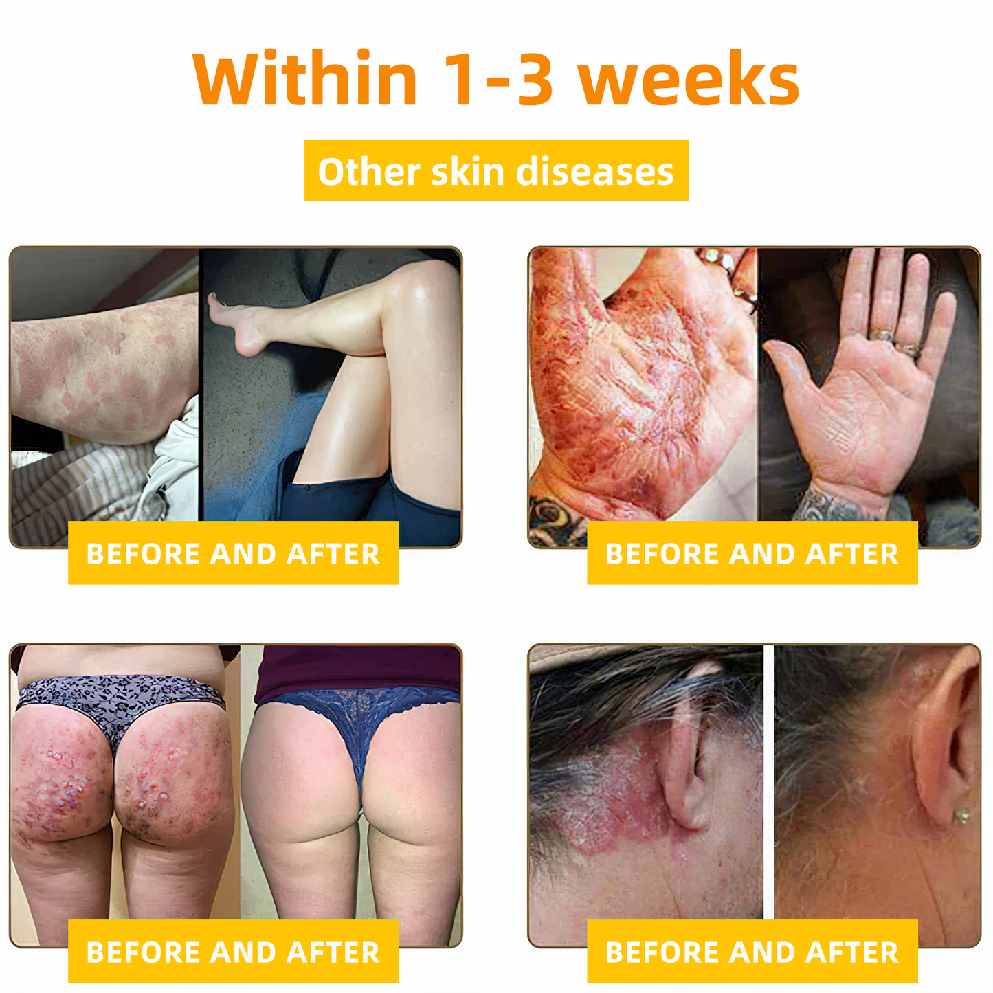 NESLEMY™ Bee Poison Skin Cream（👨‍⚕AAD Recommended),for Remove Warts, Acne and Scars