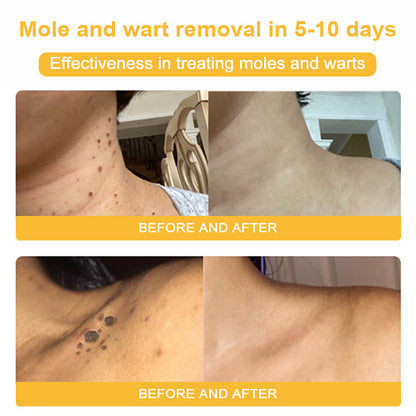 NESLEMY™ Bee Poison Skin Cream（👨‍⚕AAD Recommended),for Remove Warts, Acne and Scars